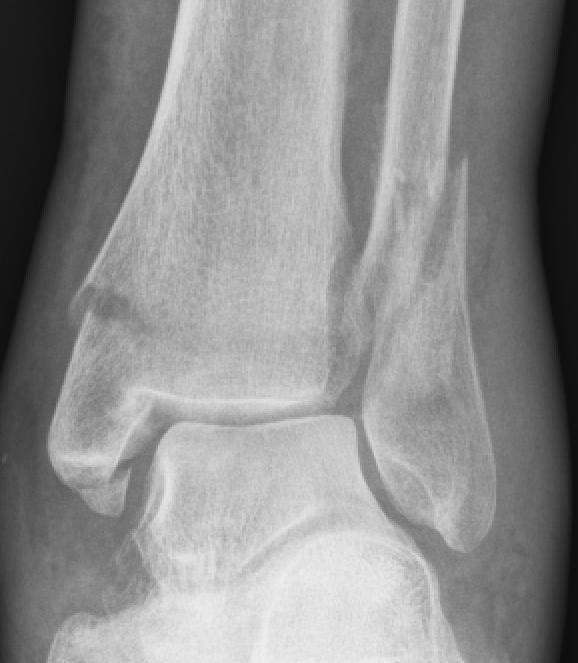 Ankle Fracture Foot Fracture Foot and Ankle Center